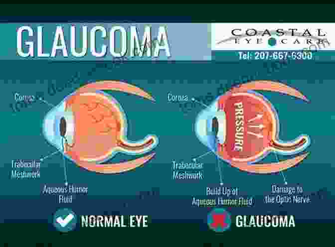 Glaucoma Management Treatment Ophthalmology Gerhard K Lang